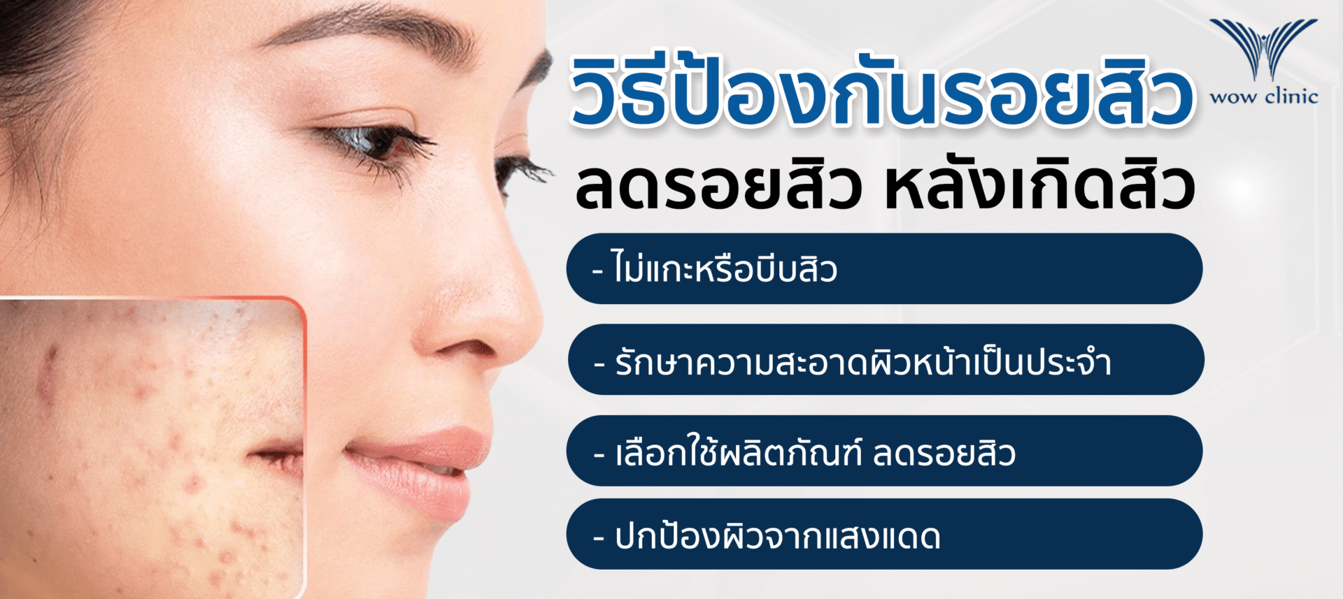 วิธีป้องกัน รอยสิว และ ลดรอยสิว หลังเกิดสิว