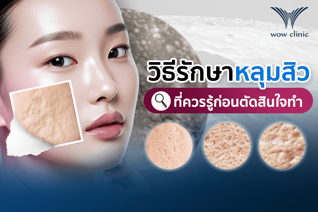 วิธีรักษาหลุมสิว ที่ควรรู้ก่อนตัดสินใจทำ