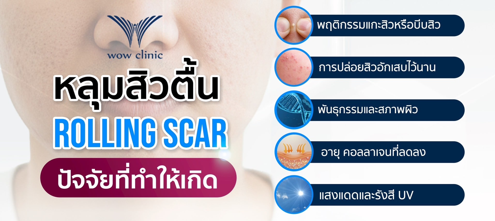 หลุมสิวตื้น Rolling Scar กับปัจจัยที่ทำให้เกิด