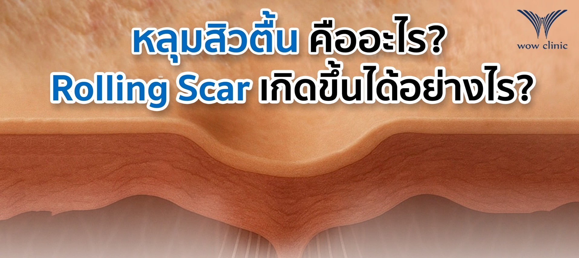 หลุมสิวตื้น คืออะไร และ Rolling Scar เกิดขึ้นได้อย่างไร