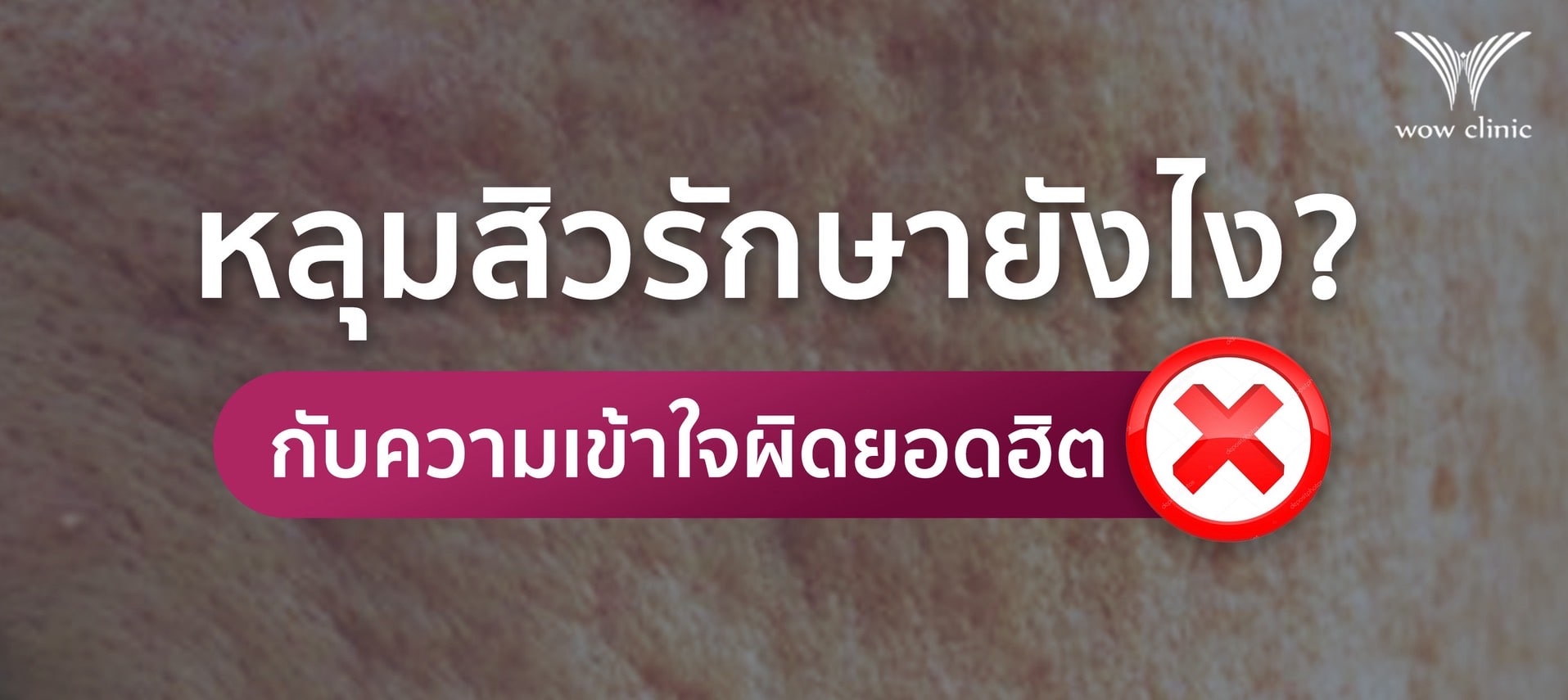 หลุมสิวรักษายังไง กับความเข้าใจผิดยอดฮิต