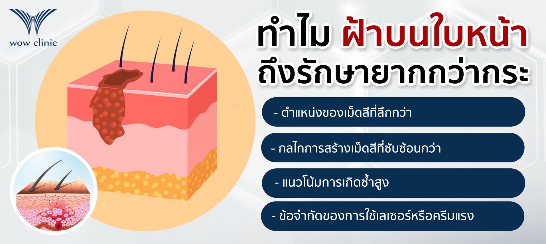 ทำไม ฝ้าบนใบหน้า ถึงรักษายากกว่ากระ