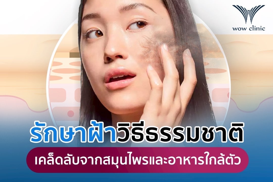 รักษาฝ้าวิธีธรรมชาติ ด้วยสมุนไพรและอาหารใกล้ตัว