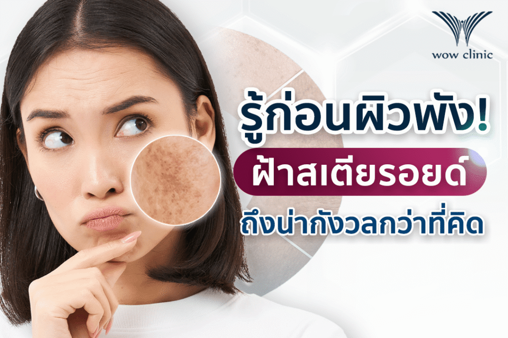 รู้ก่อนผิวพัง! ทำไม “ฝ้าสเตียรอยด์” น่ากังวลกว่าที่คิด