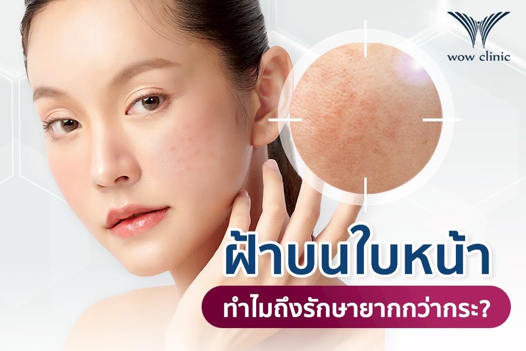 ฝ้าบนใบหน้า ทำไมถึงรักษายากกว่ากระ