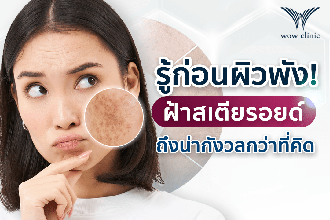 รู้ก่อนผิวพัง! ทำไม “ฝ้าสเตียรอยด์” น่ากังวลกว่าที่คิด รู้ก่อนผิวพัง! ทำไม “ฝ้าสเตียรอยด์” น่ากังวลกว่าที่คิด