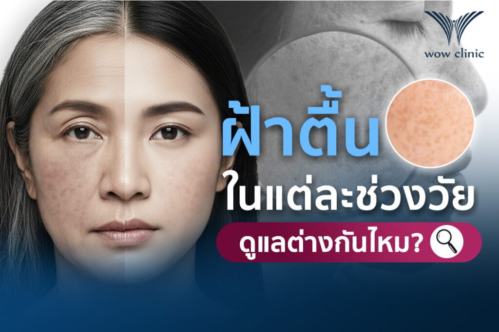 ฝ้าตื้น แต่ละช่วงวัย ดูแลต่างกันไหม