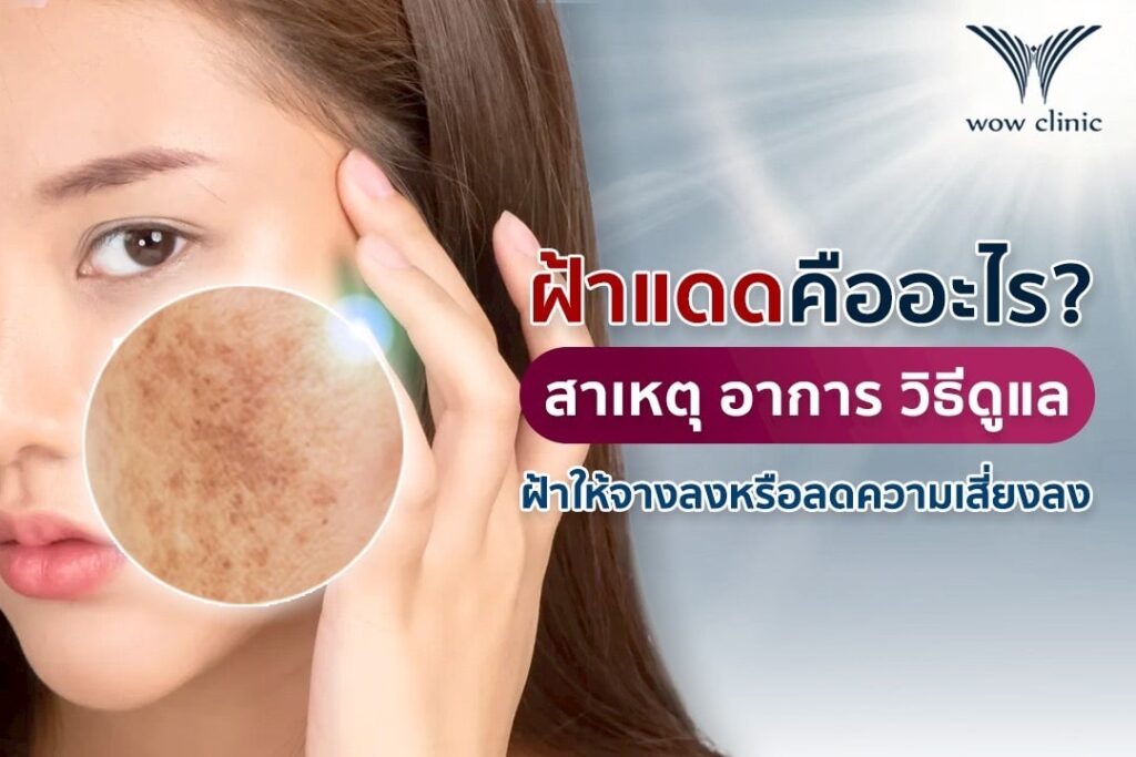 ฝ้าแดดคืออะไร บอกสาเหตุและวิธีดูแล ฝ้าบนใบหน้า