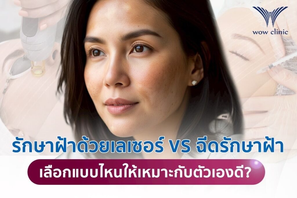 รักษาฝ้าด้วยเลเซอร์ vs ฉีดรักษาฝ้า ต่างกันอย่างไร เลือกแบบไหนให้เหมาะกับตัวเองดี