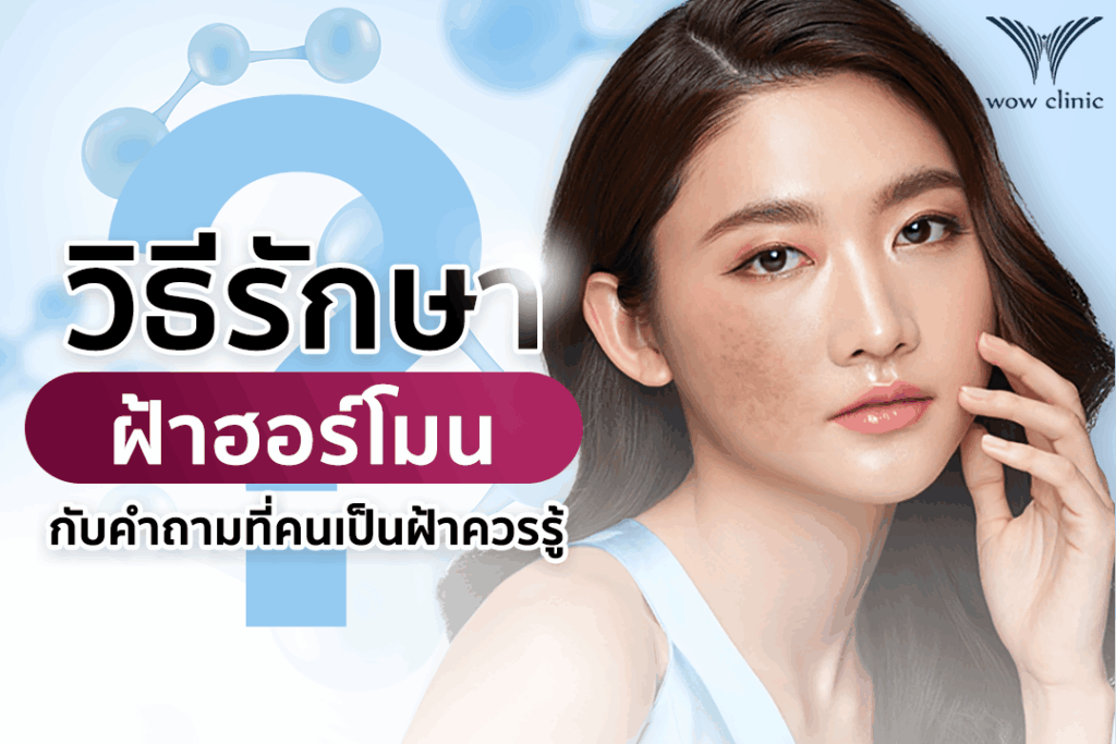 วิธีรักษาฝ้าฮอร์โมน กับคำถามที่คนเป็นฝ้าควรรู้